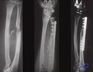 ORIF - Plating of one or both bones for Multifragmentary ...