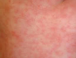 Roseola infantum is a common, mild, viral infection that can cause a temperature and rash in babies and young children. Roseola Dermnet Nz