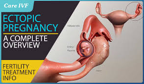 Consult a doctor for medical advice. Ectopic Pregnancy Symptoms Risk Factors Causes Treatment Options And Effect On Fertility