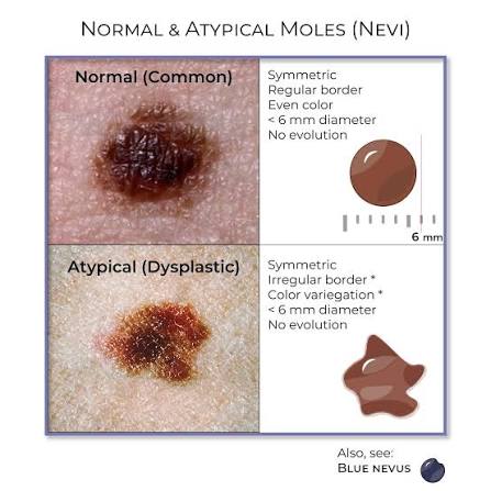 Mole (Nevus) [Normal & Typical] - Clinical Pathology Flashcards | ditki  medical and biological sciences