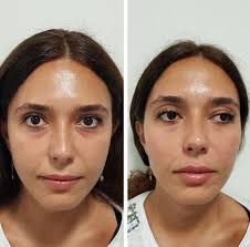Arranging your consultation is simple. Cheek Enhancement Augmentation Fillers In London
