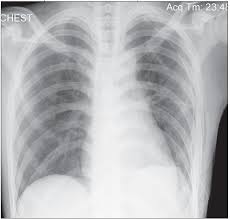 It typically happens when there is a rupture of a small air sac on the outside of the lung. Case In Point Spontaneous Pneumothorax In A Teenage Boy Consultant360