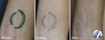 Tattoos used to be considered permanent, but thanks to the results from this research look promising. Laser Tattoo Removal Results Photos New Look Laser College