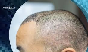 انتفاخ الوجه بعد زراعة الشعر ما هي الأسباب وطرق العلاج Infinity Hair Sleep Eye Mask Eyes Mask