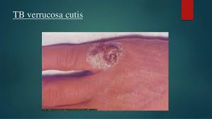 Tuberculosis cutis verrucosa tuberculosis cutis verrucosa (icd10: Cutaneous Tuberculosis