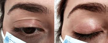 May 10, 2021 · covid : Maladies Et Troubles Oculaires Institut Catala De Retina