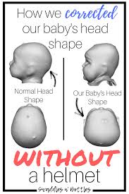How We Fixed Our Baby S Flat Head Without A Helmet Baby Head Shape Flat Head Baby Baby Helmet