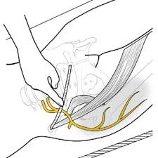 Image result for Pelvic Compression Test