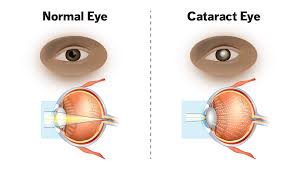What Are Cataracts Understanding Symptoms And Treatment