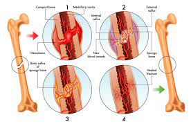 Strategies To Help Heal Your Broken Bones Direct Orthopedic Care