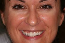 Dental Bridges & Crowns