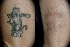 Proper care for the tattoo is crucial or scarring/infection may occur. Laser Tattoo Removal Los Angeles Pasadena Cosmetic Surgery