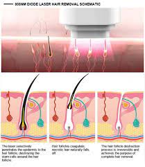 (i'm partly southern italian with robust hair follicles—what can i say?) obviously the kid was a jerk and there's nothing wrong with body hair, but the fact remained that as i. All About Laser Hair Removal Cost Pain And More