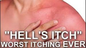 Jun 09, 2019 · how to stop sunburn itch fast use gentle moisturizers. I Have Experienced Hell S Itch An Uncontrollable Painful Scratching On Your Sunburned Skin Youtube