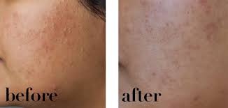 What do you think about the inkey list niacinamide vs the ordinary's niacinamide review? Deciem The Ordinary Niacinamide Serum One Month Review With Before After Photos The Ordinary Niacinamide Ordinary Effective Skin Care Products