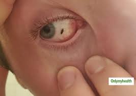 Don't try to pry the lens off if you still don't see it, flip your upper eyelid to see if it's hiding up there, then try saline drops to flush it out. What To Do When You Get Something Like A Bug In Your Eye