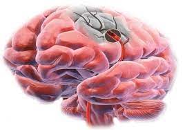 Mini accidente cerebrovascular en comparación con accidente cerebrovascular: Isquemia Cerebral Como Detectarla