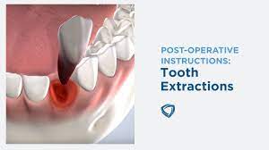 Maybe you would like to learn more about one of these? Post Operative Instructions Tooth Extraction At Columbia Basin Oral Maxillofacial Surgeons