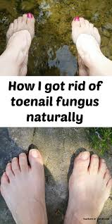 You should try tea tree oil before other, more tea tree essential oil can treat acne, eczema, toenail fungus, scabies, ringworm, warts among other things like lice and scalp problems. How I Got Rid Of Toenail Fungus Quickly Naturally Feathers In The Woods