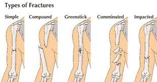 Survival Medicine Hour Poison Plants Setting A Fracture More Types Of Fractures Medicine First Aid