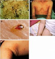 Image result for scabies on humans