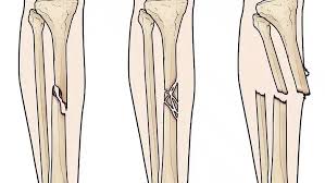 Fisioterapia Sportiva Milano - Dott. Creperio Fisioterapista