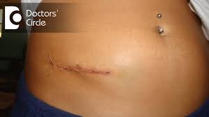 Do i need surgery and, if so, how soon? What Is The Recovery Time From Laparoscopic Appendectomy Dr Sathish N Youtube