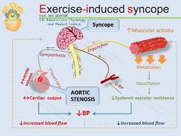 Image result for Exercise Induced Syncope