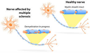 Multiple sclerosis (ms) is a chronic inflammatory disease in which the myelin sheath on the nerve endings gets inflamed and damaged. Optic Neuritis And Multiple Sclerosis
