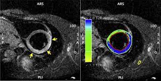 ► shoulder ► elbow ► wrist ► finger ► thumb. Cardiac Magnetic Resonance Assessment Of Myocarditis Circulation Cardiovascular Imaging