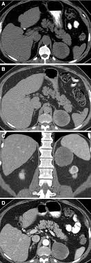 Pathologic conditions, pearls, and pitfalls. Adrenal Cortical Adenoma Current Update Imaging Features Atypical Findings And Mimics Springerlink