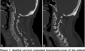 Image result for Chance Fracture