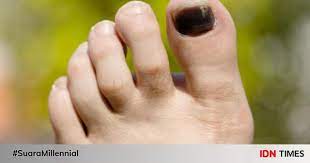 Kuku kaki yang menghitam karena cedera disebabkan oleh pembuluh darah yang rusak. Jangan Dibiarkan Ternyata Ini 7 Fakta Kuku Kaki Jadi Hitam Dan Tebal