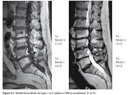 Pour les articles homonymes, voir l1, l2, l3, l4 et l5. Douleurs Lombaires Raison Principale Des Arrets De Travail