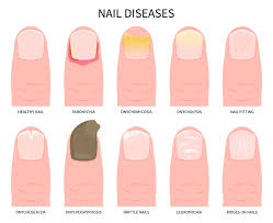 Image result for Pitting nails feet