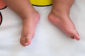 Image result for Out-toeing