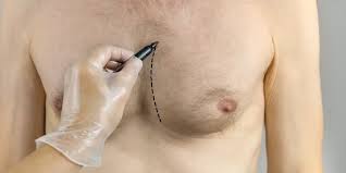 Image result for Gynecomastia