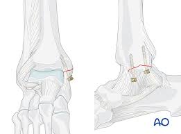 The medial malleolus is a spherical bony protrusion just above the ankle on the inside of the leg. Medial Transverse Fracture Lag Screws
