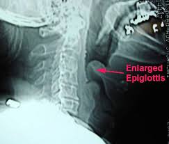 Image result for Epiglottitis