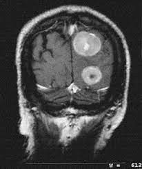We detail the clinical presentation in the second patient with pleural malignant mesothelioma thus far reported to develop brain metastases. Cerebral Metastases In Malignant Mesothelioma Case Report And Literature Review Sciencedirect