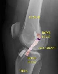An acl reconstruction surgery involves the replacement of anterior cruciate ligament by a tissue graft. Acl Injury Does It Require Surgery Orthoinfo Aaos