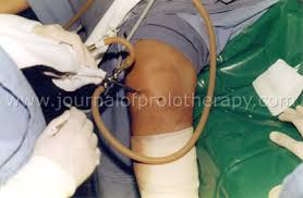 Prolotherapy For Meniscus Tears Caring Medical Florida
