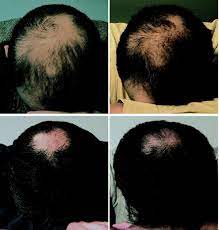 Taking hormone replacement therapy (hrt) can slow down or even stop hair loss in some women. Exactly How Trans Hormone Replacement Therapy Regrows Hair Photos