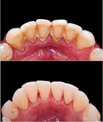 Raspagem Periodontal limpeza gengiva Guará Brasília