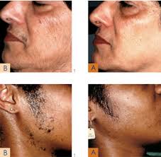 There are various excellent laser hair removal systems. Laser Hair Removal Coral Medical Health Spa