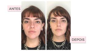 Minha experiência com a Harmonização Facial: relatos reais