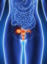 Yes, you still have a risk of ovarian cancer or a type of cancer that acts just like it (primary peritoneal cancer) if you've had a hysterectomy. Ovarian Cancer Diagnosis Why Early Detection Is So Difficult