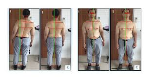 Lower Back Pain Lean To One Side