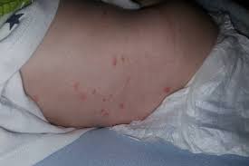 It's more common in meningococcal disease, though, with about 50% of infected people developing petechiae. Horrifying Photos Show How Meningitis Rash Grew From A Few Dots To Cover Baby S Whole Body In 24 Hours Mirror Online