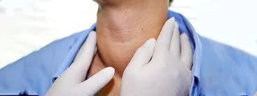 Thyroid cancer diagnoses are on the rise. Goiter Johns Hopkins Medicine